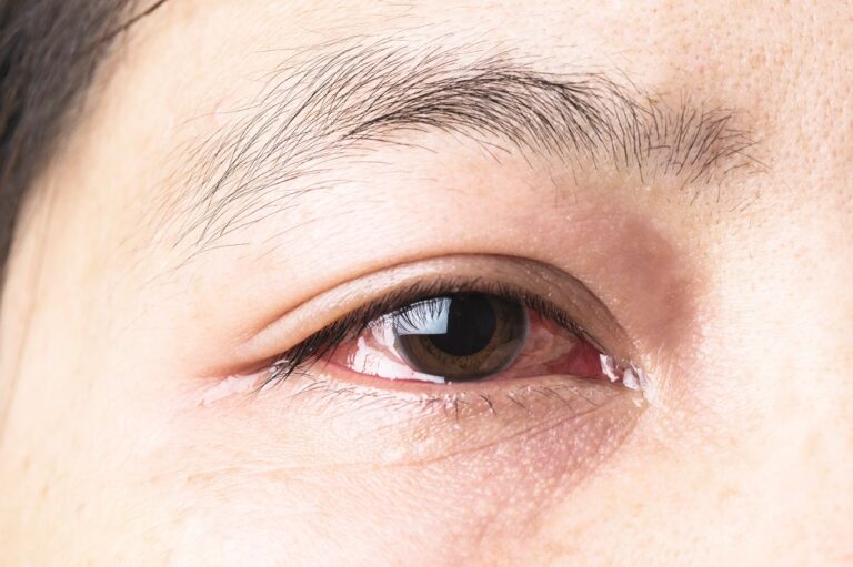 Potential Causes Of The Reason Why Eyes Are Not The Same