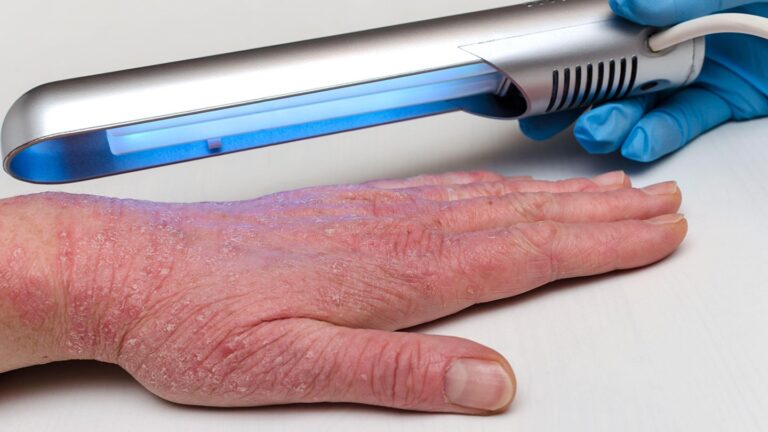 pros-and-cons-of-eczema-light-therapy-1440x810