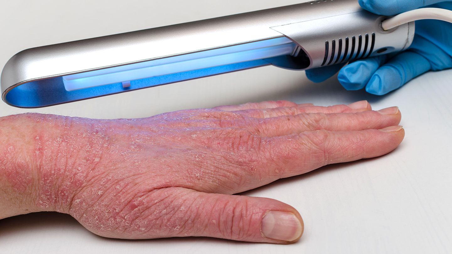 pros-and-cons-of-eczema-light-therapy-1440x810