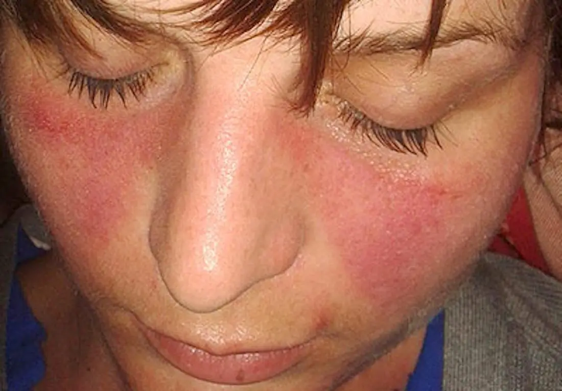a-malar-rash-is-a-symptom-of-lupus-image-credit-doktorinternet-2013
