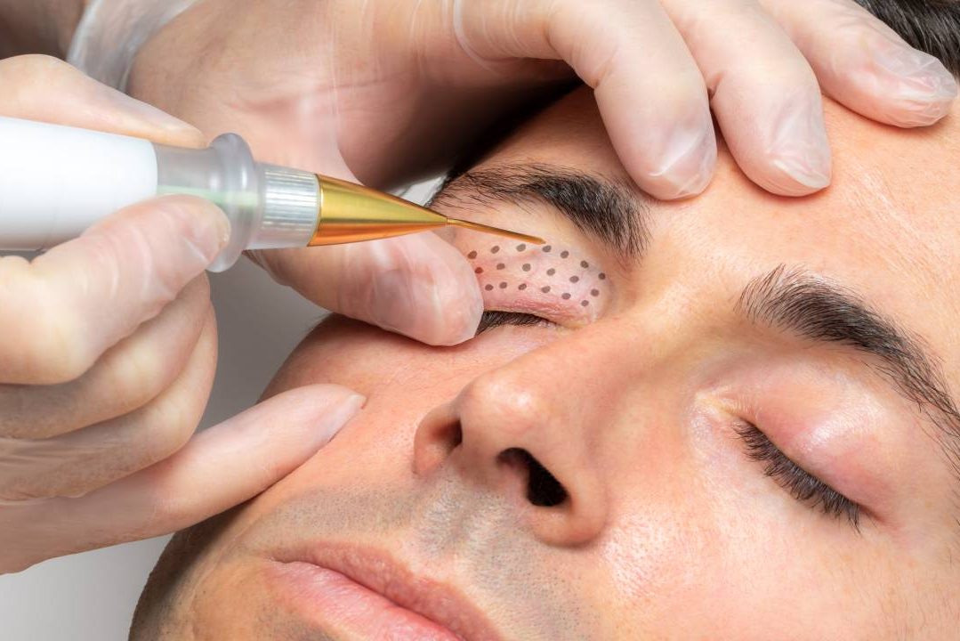 Do You Know How Plasma Skin Tightening Treatment Works