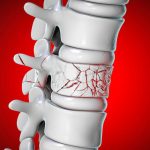 Pain Management After Spinal Fracture Surgery