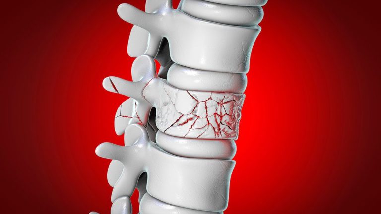 Pain Management After Spinal Fracture Surgery